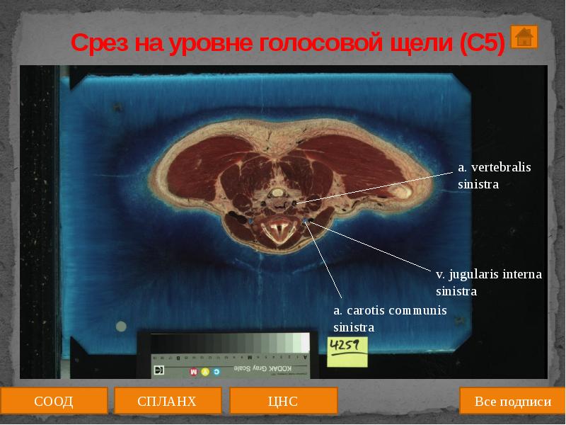 Срез работ. Визуализация голосовой щели. степень визуализации голосовой щели. работа на срез. срезы на виджетах.