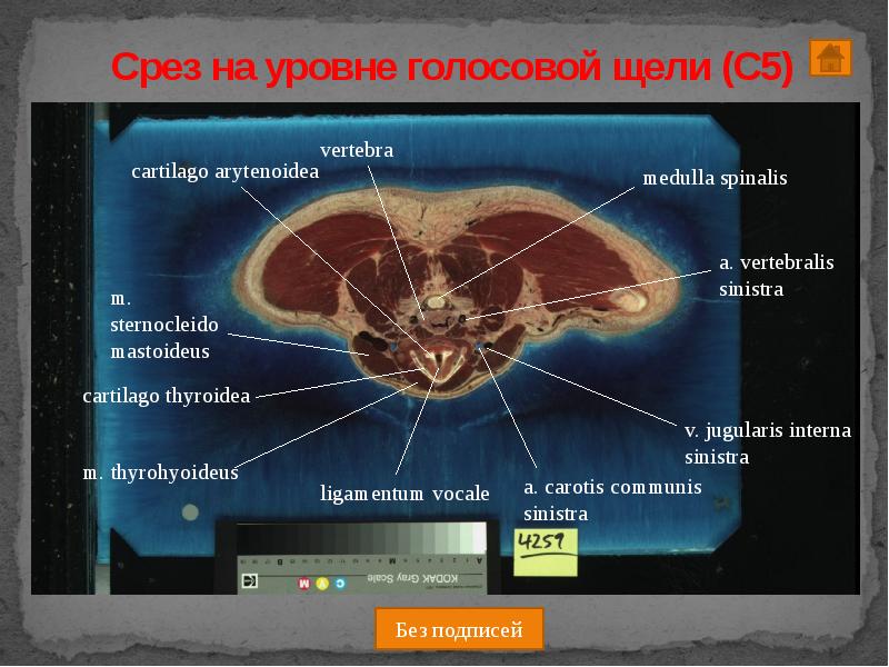 Срез работ. Степень визуализации голосовой щели. работа на срез. орбита срез без подписей. cartilago arytenoidea.