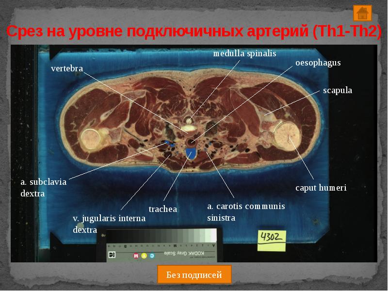 Срез работ. Поперечный срез человека. medulla spinalis поперечный срез. поперечный срез живота на уровне th12. срез на уровне с2.