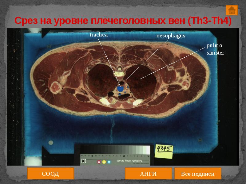 Срез работ. Работа на срез. трахея th3 th4.