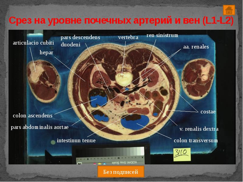 Срез работ. Срез на уровне почек. поперечный срез человека. срез томограммы на уровне почек.