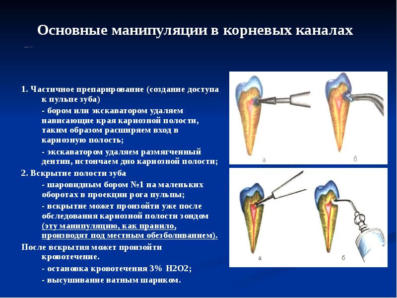 Передние зубы каналы