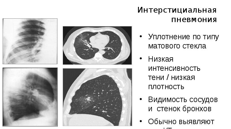 Картина двухсторонней полисегментарной пневмонии кт