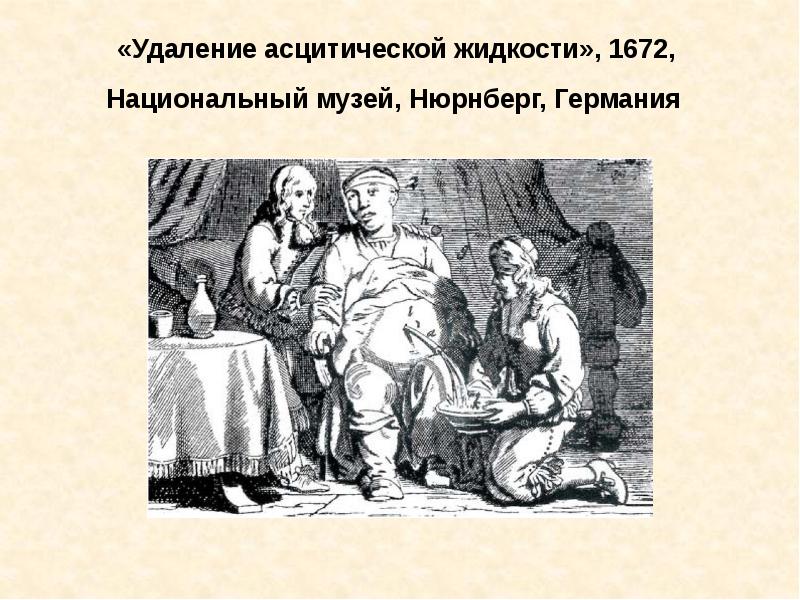 «Удаление асцитической жидкости», 1672,  Национальный музей, Нюрнберг, Германия