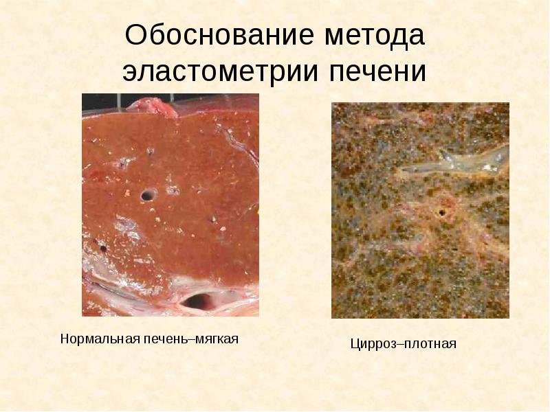 Обоснование метода эластометрии печени