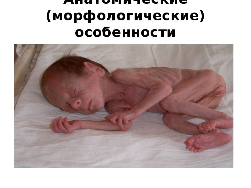 Анатомические (морфологические) особенности недоношенных