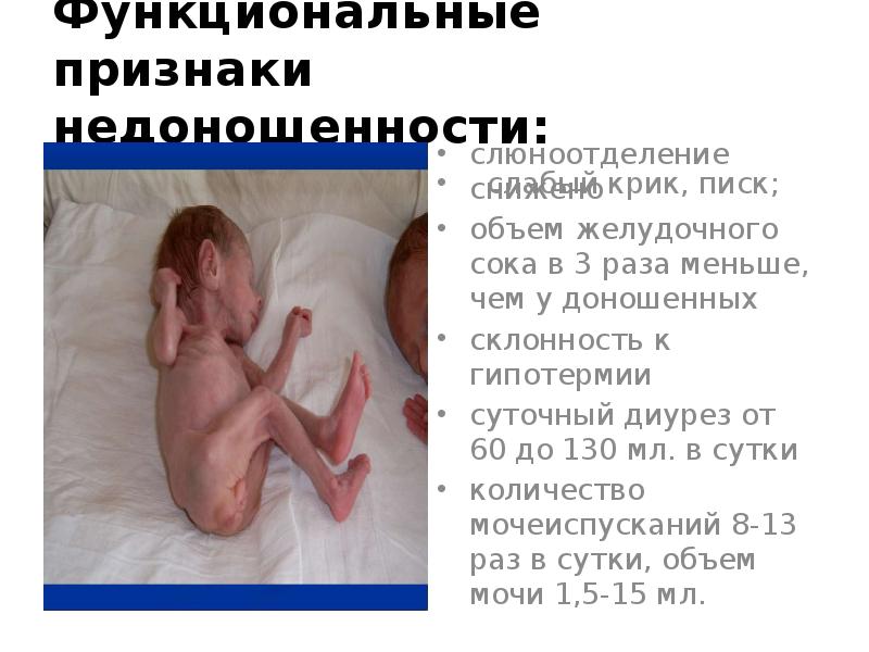 Функциональные признаки недоношенности: