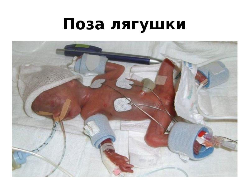 Поза лягушки