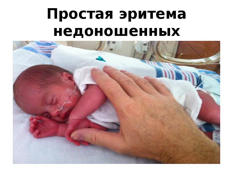 Простая эритема недоношенных