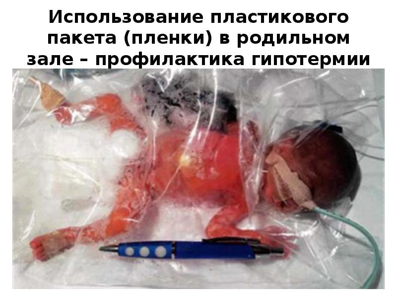 Использование пластикового пакета (пленки) в родильном зале – профилактика гипотермии