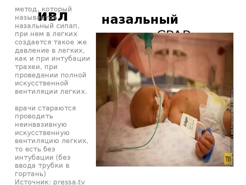 ивл  назальный сипап- CPAP