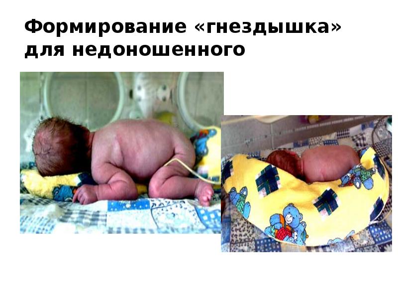 Формирование «гнездышка» для недоношенного