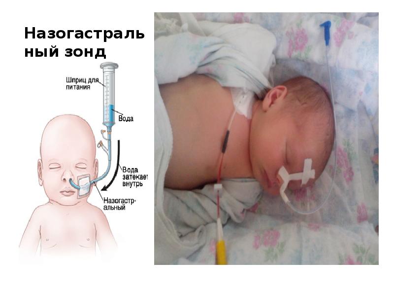 Назогастральный зонд