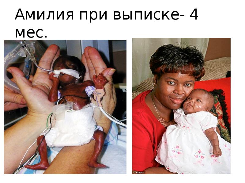 Амилия при выписке- 4 мес.