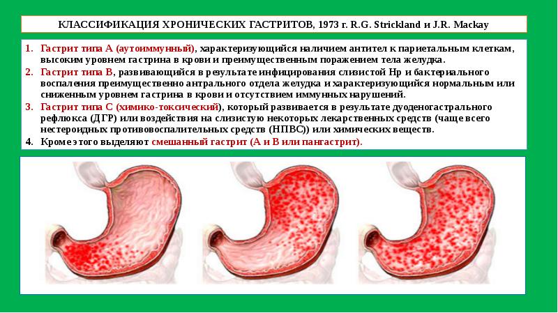 Презентация по язвенной болезни желудка - 98 фото