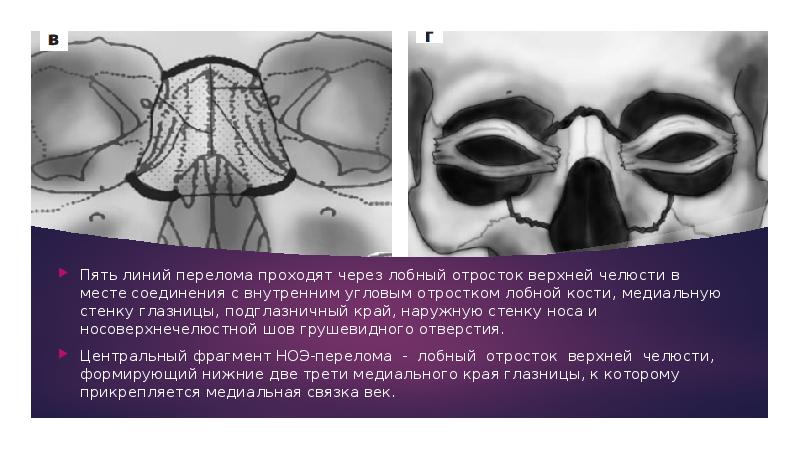 Перелом медиальной стенки орбиты