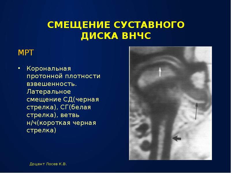 Память смещение. Подвывих диска височно-нижнечелюстного сустава. Вентральная дислокация диска ВНЧС. Латеральный подвывих ВНЧС.