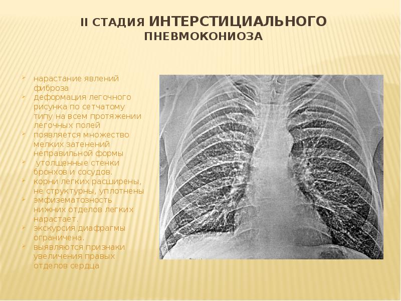 Деформация легочного рисунка по мелкоячеистому типу