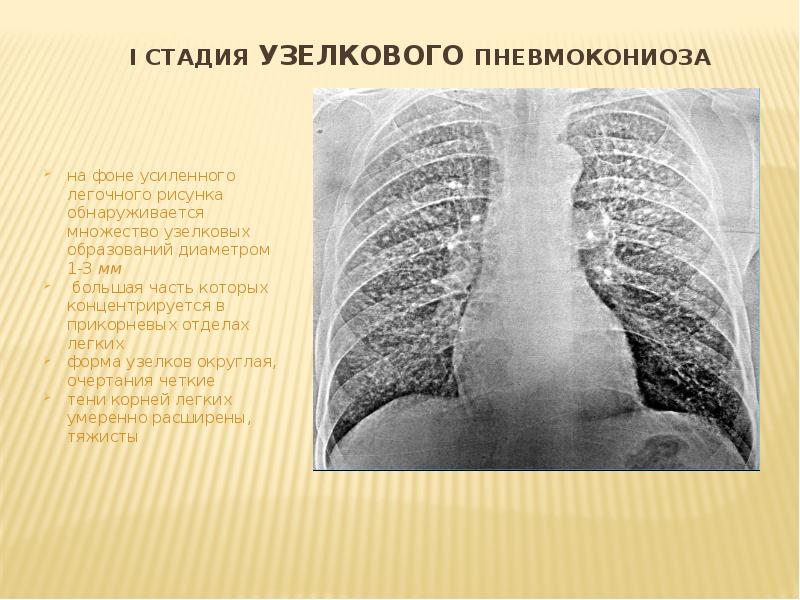 Легочный рисунок деформирован в медиальных зонах что это