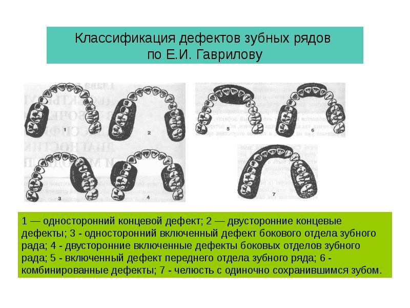 Классификации дефектов зубного ряда презентация