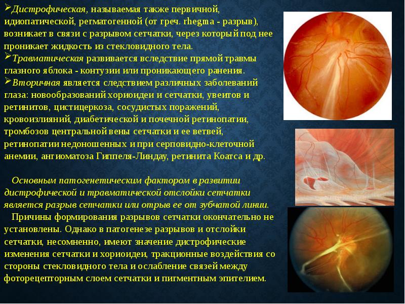 Диагноз сетчатки. Периферическая хориоретинальная дистрофия (ПХРД). Периферические дистрофии сетчатки атлас. Опухоли зрительного нерва глазное дно. Этиопатогенез пигментной дистрофии сетчатки.