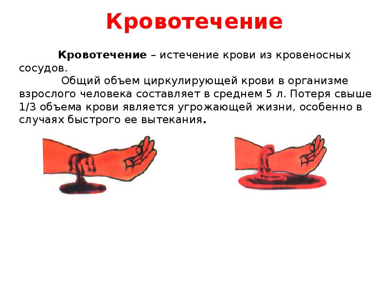 Первая помощь при кровотечениях обж презентация