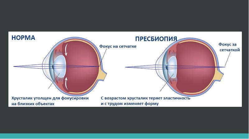 Пресбиопия что. Пресбиопия причины возникновения коррекция. Возрастная дальнозоркость. Пресбиопия глаз коррекция. Хрусталик глаза пресбиопия.