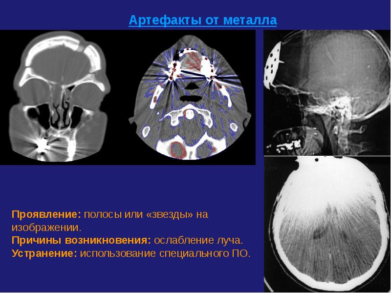 Артефакты мрт презентация