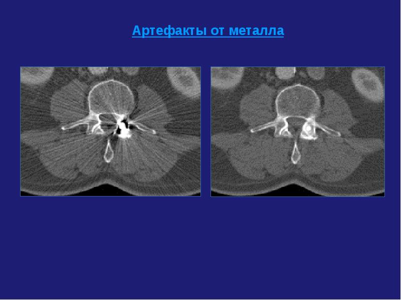 Артефакты кт изображений