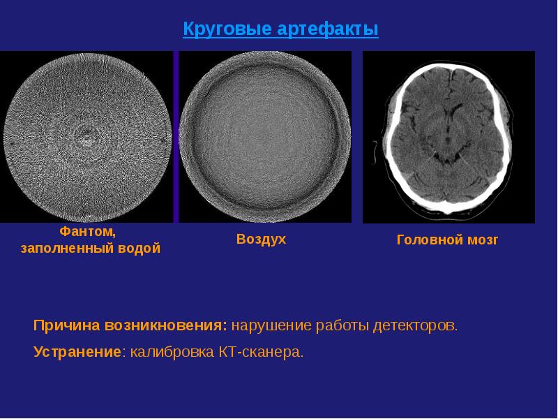 Артефакты мрт презентация