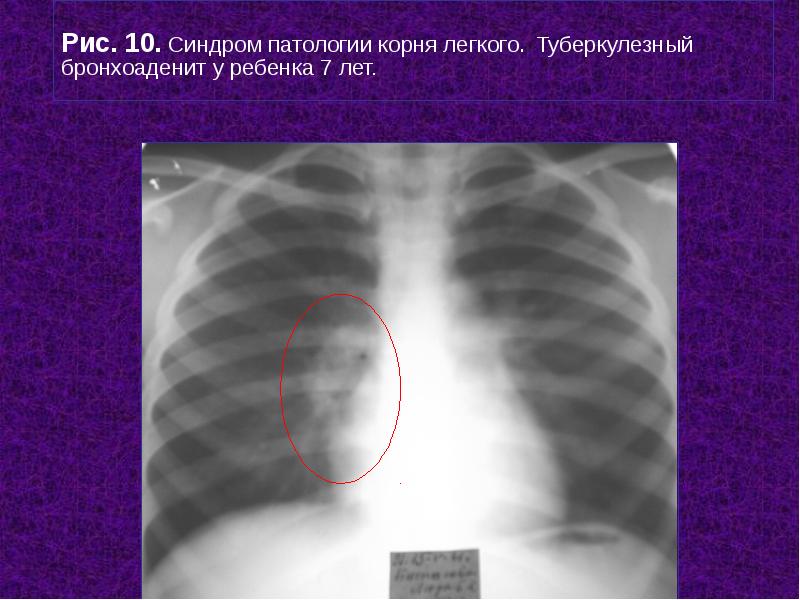 Усилен легочный рисунок в прикорневых отделах у ребенка