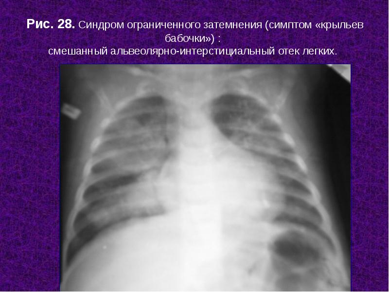 Отек легких рентгенологическая картина