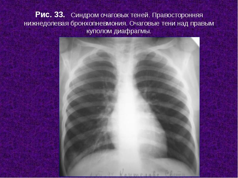 Усиленный рисунок легких на рентгене у ребенка