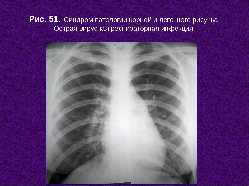 Изменения легочного и корневого рисунка