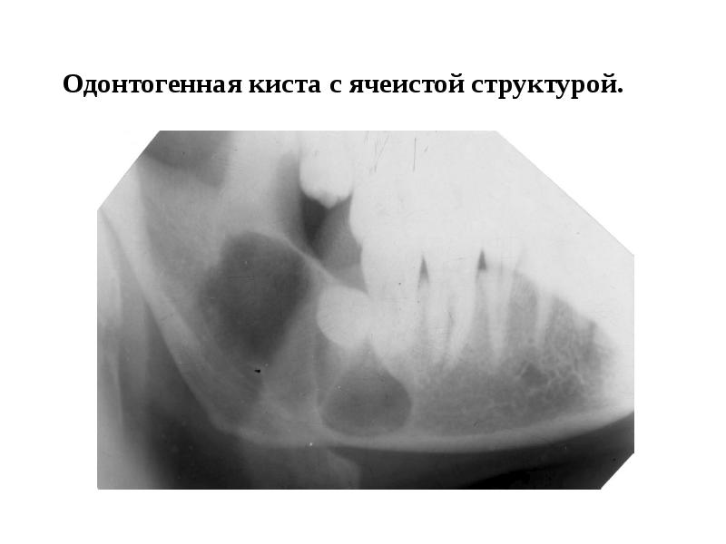 Неодонтогенные кисты презентация