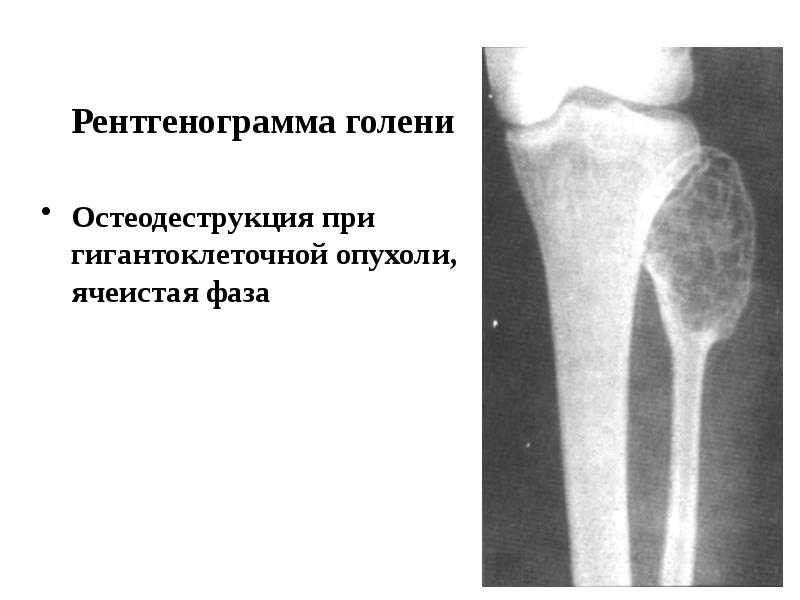 Рентгенологическая картина гигантоклеточной опухоли характеризуется разновидностями