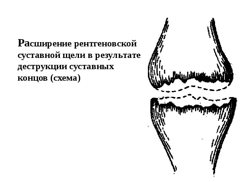 рентгеновская суставная щель. изменение высоты рентгеновской суставной щели схема. деформирующий артроз коленного сустава рентген степени. суставная щель склерозированы. рентгеновская суставная щель.