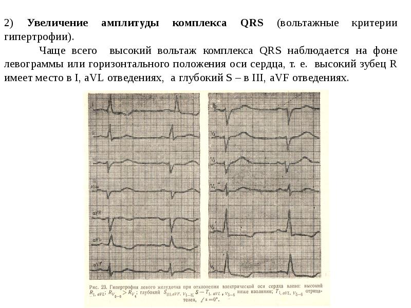 Комплекс увеличение. Амплитуда QRS ЭКГ. Вольтаж зубца r на ЭКГ. Вольтаж комплексов QRS на ЭКГ. Высокий Вольтаж зубцов комплекса QRS.