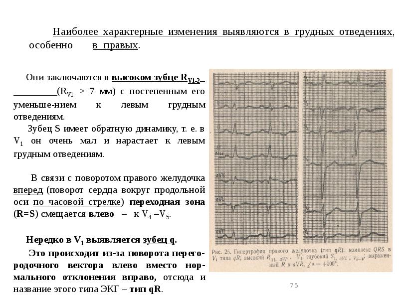 Отклонение оси вправо на экг. Переходная зона v1-v2 на ЭКГ.