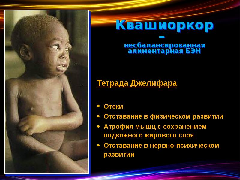 Квашиоркор –  несбалансированная алиментарная БЭН