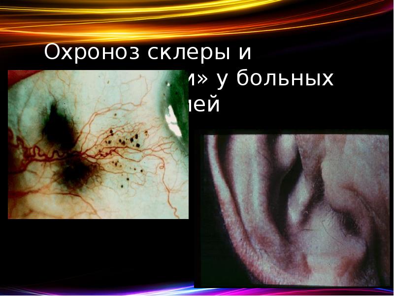 Охроноз склеры и «черные уши» у больных алкаптонурией