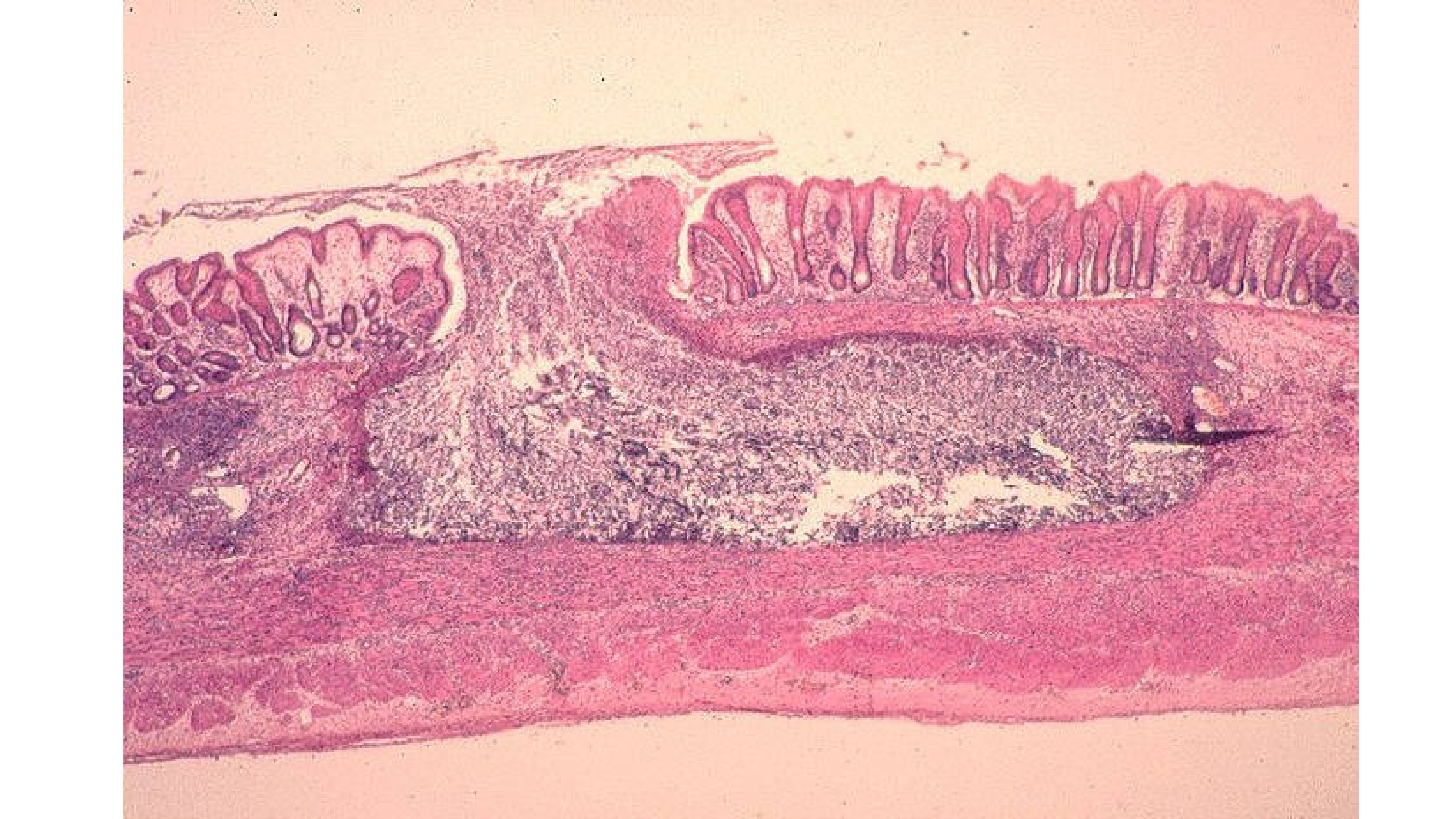 Стадия амебы поражающая толстый кишечник человека. Амебиаз кишечника микропрепарат. Амебиаз кишечника патанатомия.