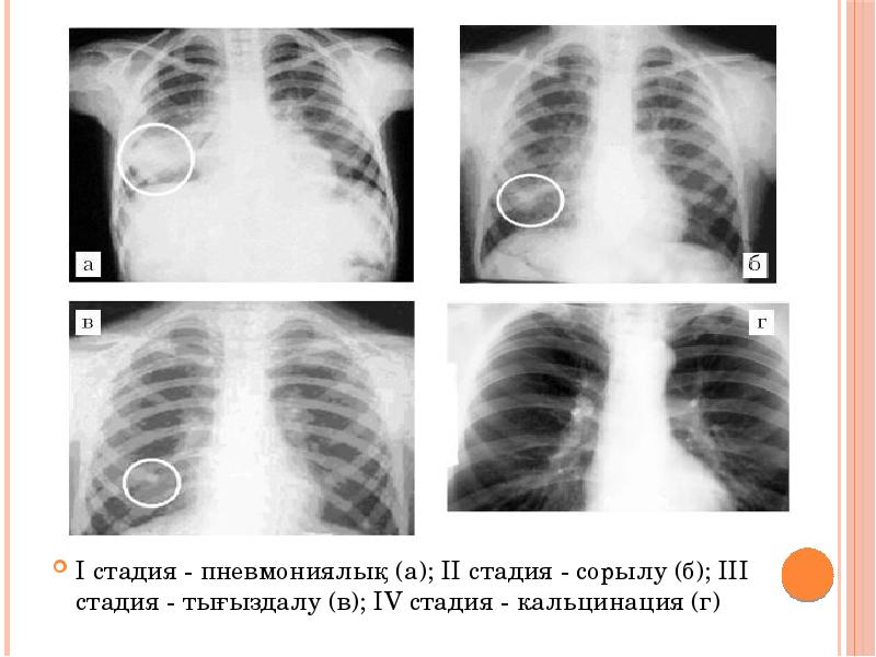 Кеуде ішілік лимфа т?йіндеріні? туберкулезі презентация