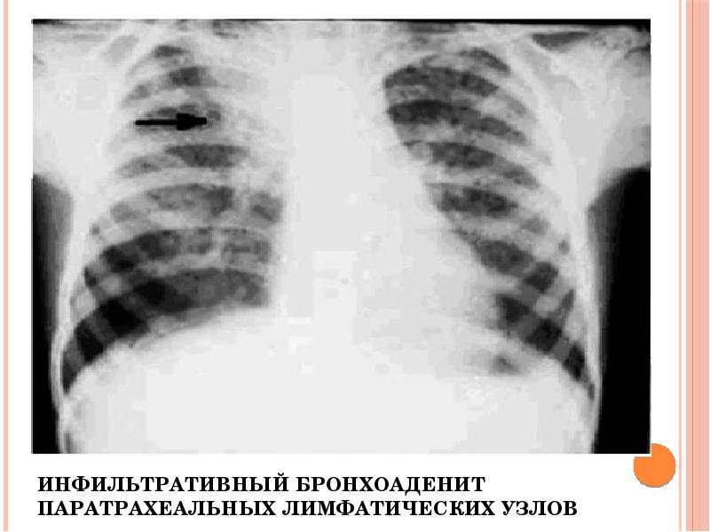 Кеуде ішілік лимфа т?йіндеріні? туберкулезі презентация