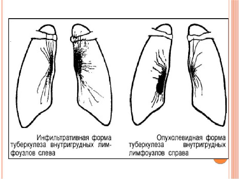 Кеуде ішілік лимфа т?йіндеріні? туберкулезі презентация