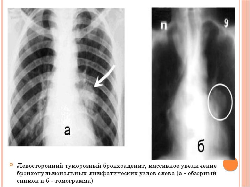 Кеуде ішілік лимфа т?йіндеріні? туберкулезі презентация