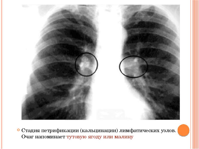 Кеуде ішілік лимфа т?йіндеріні? туберкулезі презентация