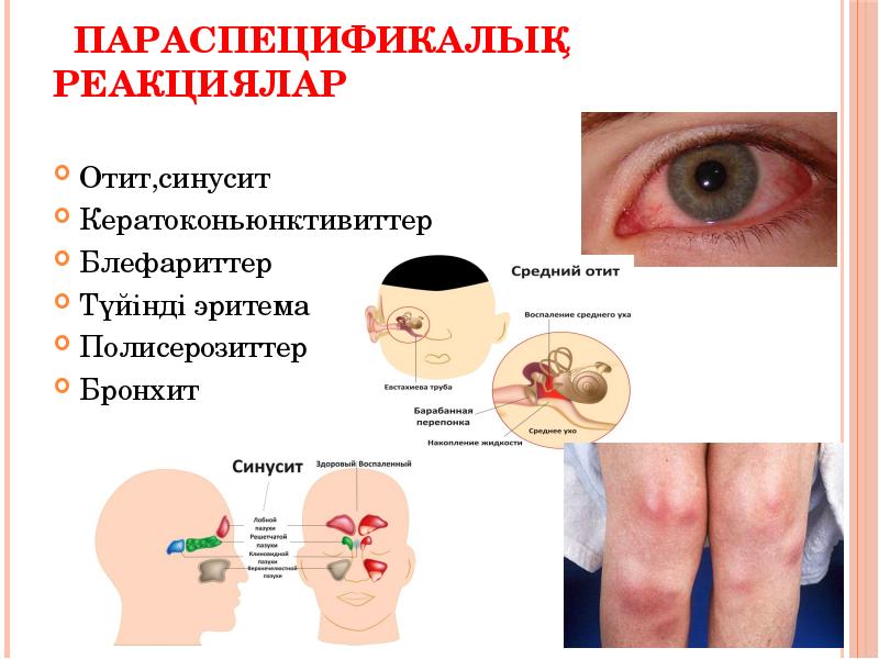 Кеуде ішілік лимфа т?йіндеріні? туберкулезі презентация