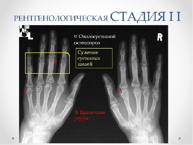 Остеопороз кистей рук фото