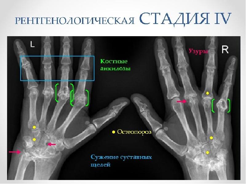 Ревматический полиартрит рентгенологическая картина